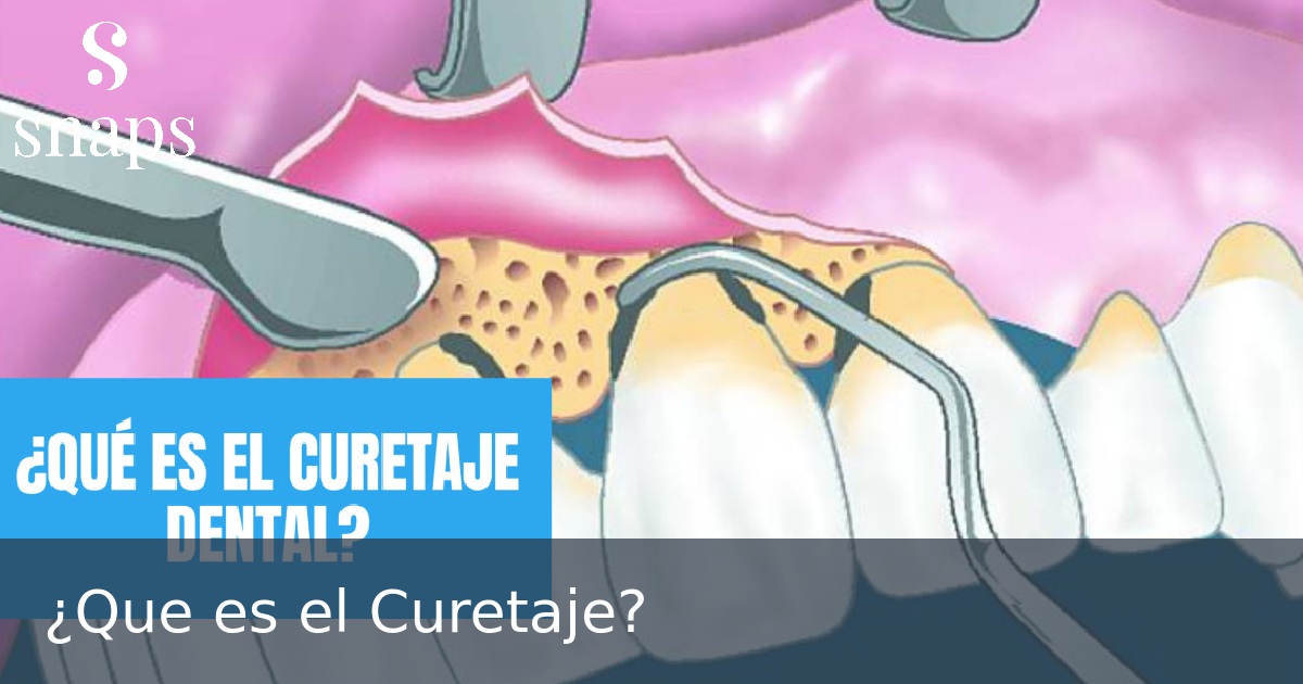 ¿Que es el Curetaje?