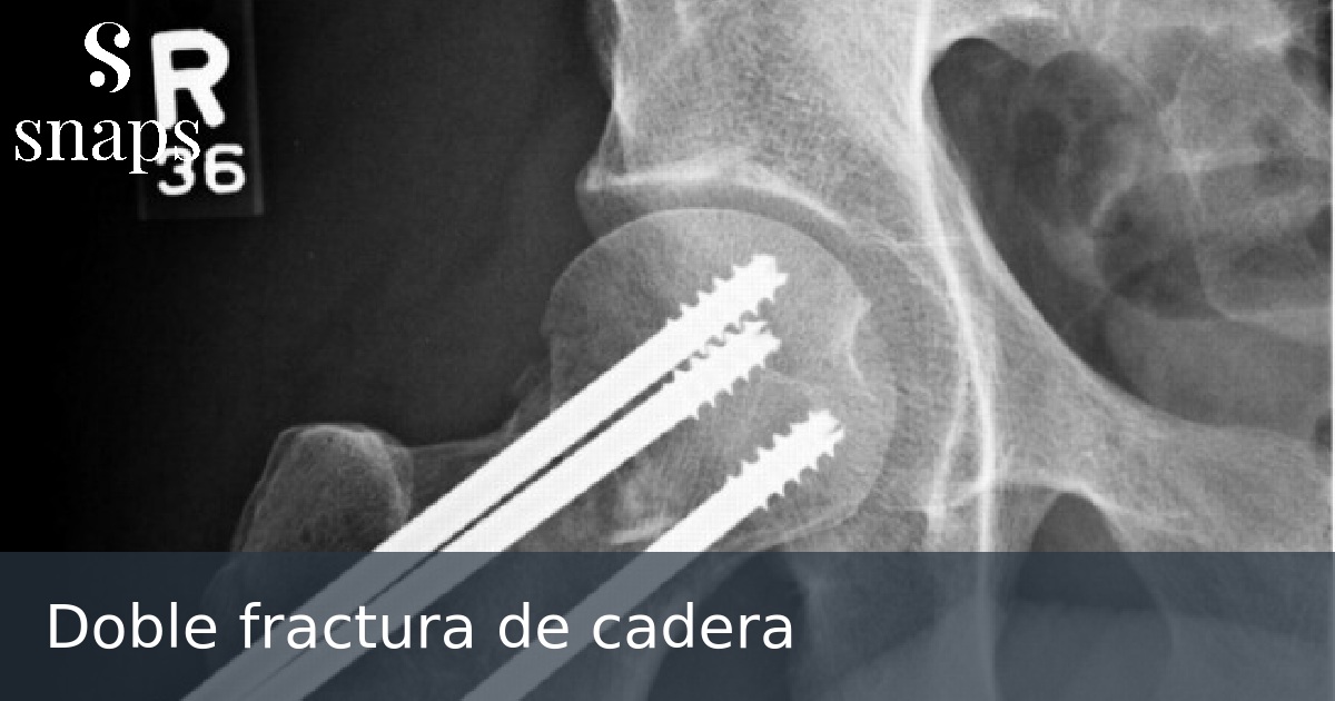 Doble fractura de cadera