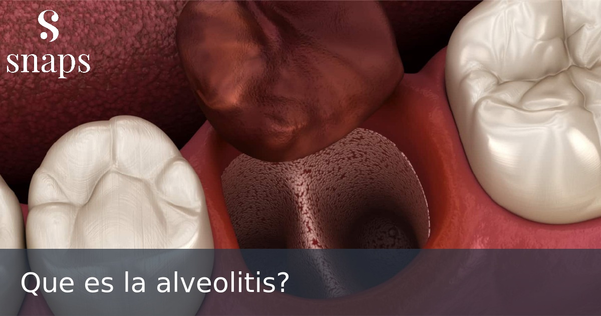 Que es la alveolitis?